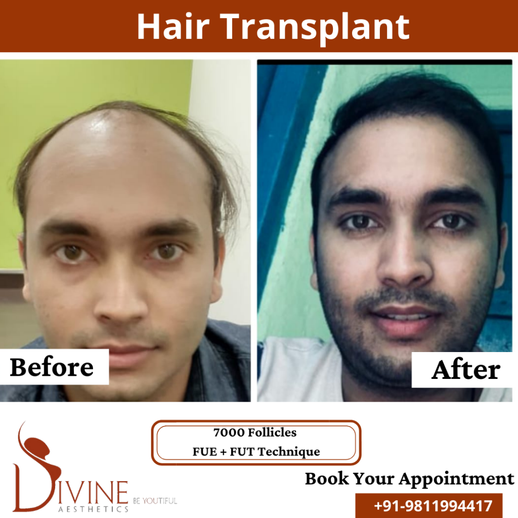 Hair Transplant