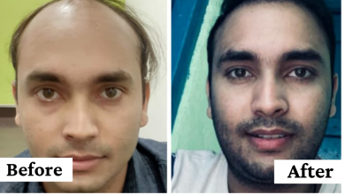 Photo of 5 Most Effective Ways to Hair Transplant Surgery in Gurgaon