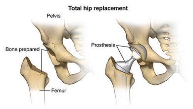 Photo of Process to Undergo for Hip Replacement Surgery