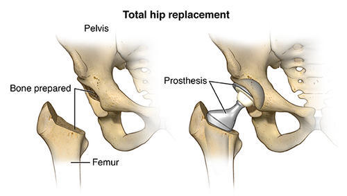 Hip Replacement in Jaipur