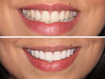 Dental Veneers