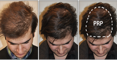 Photo of Cure your hair loss with PRP hair treatment Los Angeles