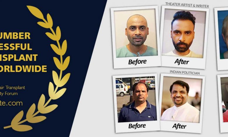 hair Transplant Doctor in Delhi