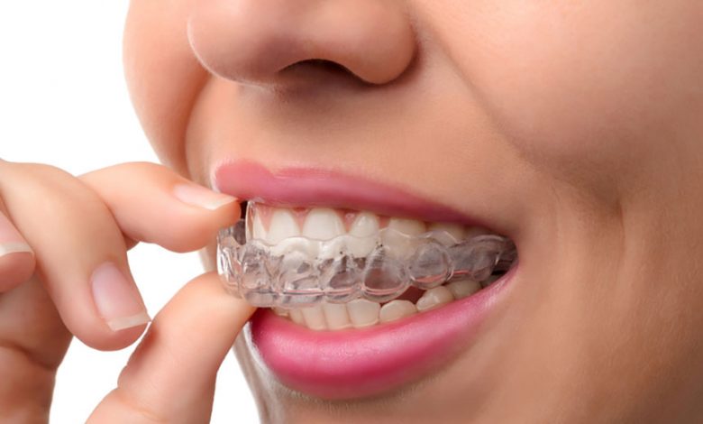 Invisalign braces