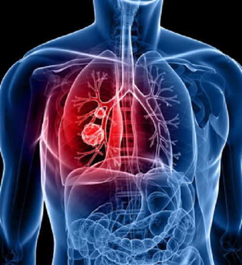 Best Lung Cancer Surgeon In Jaipur