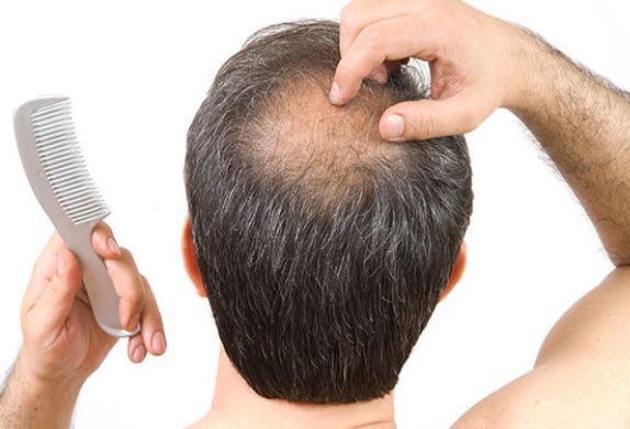 hair loss treatment 