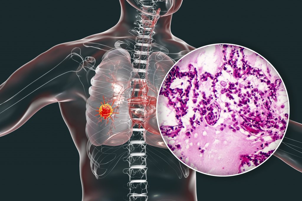 Lung cancer