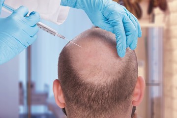 FUE hair transplant