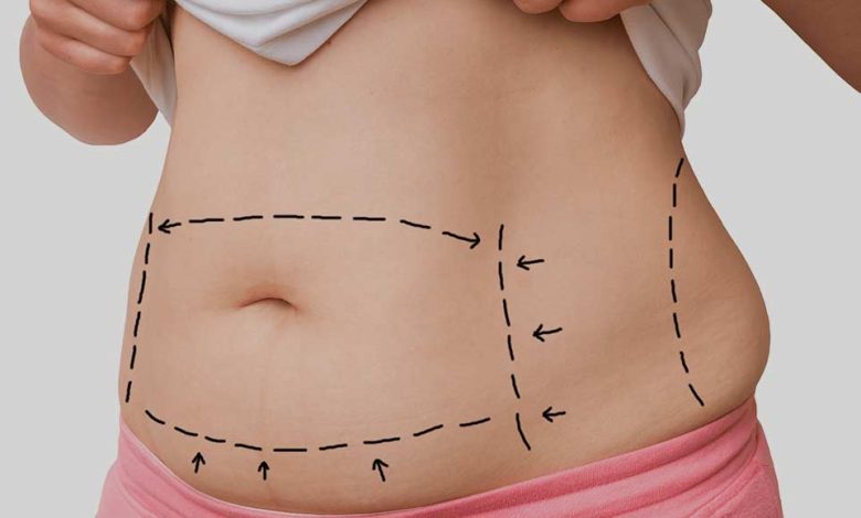 Best Liposuction Surgery Clinic