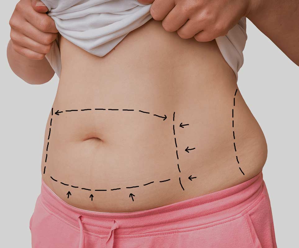 Best Liposuction Surgery Clinic