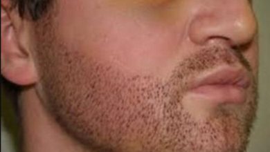 Photo of Get Permanent Natural Look Through Facial Hair Transplant