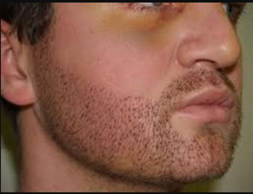 facial hair transplant