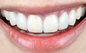 Teeth whitening