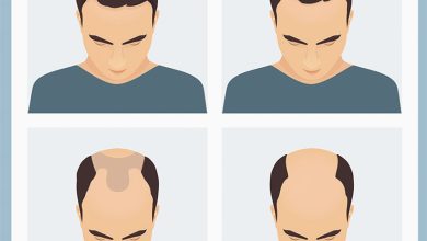 Photo of WHAT IS MALE-PATTERN HAIR LOSS, AND CAN IT BE TREATED?