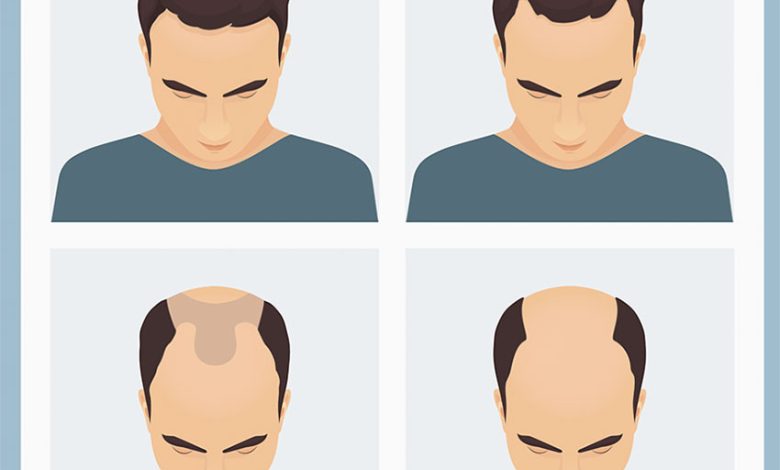 MALE-PATTERN HAIR LOSS