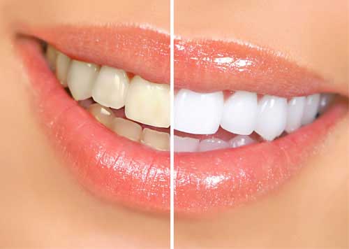 teeth whitening