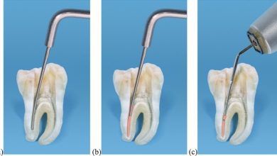 Photo of Everything You Need to Know About Root Canal Obturation