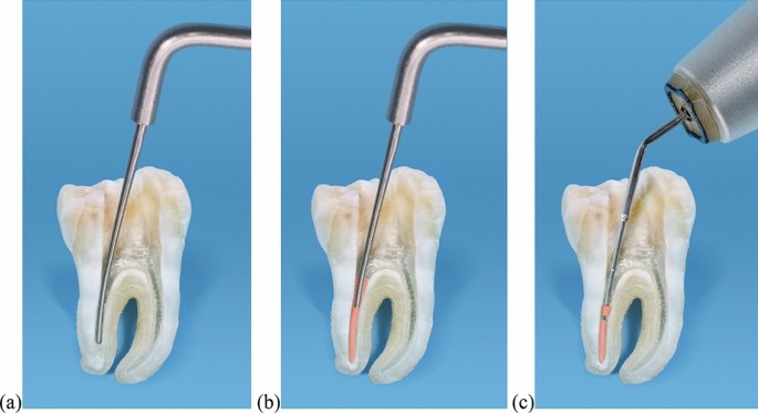 root canal obturation