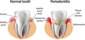 Gum Diseases