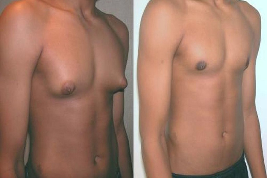 gynecomastia surgery in Vizag