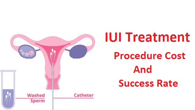 IUI treatment