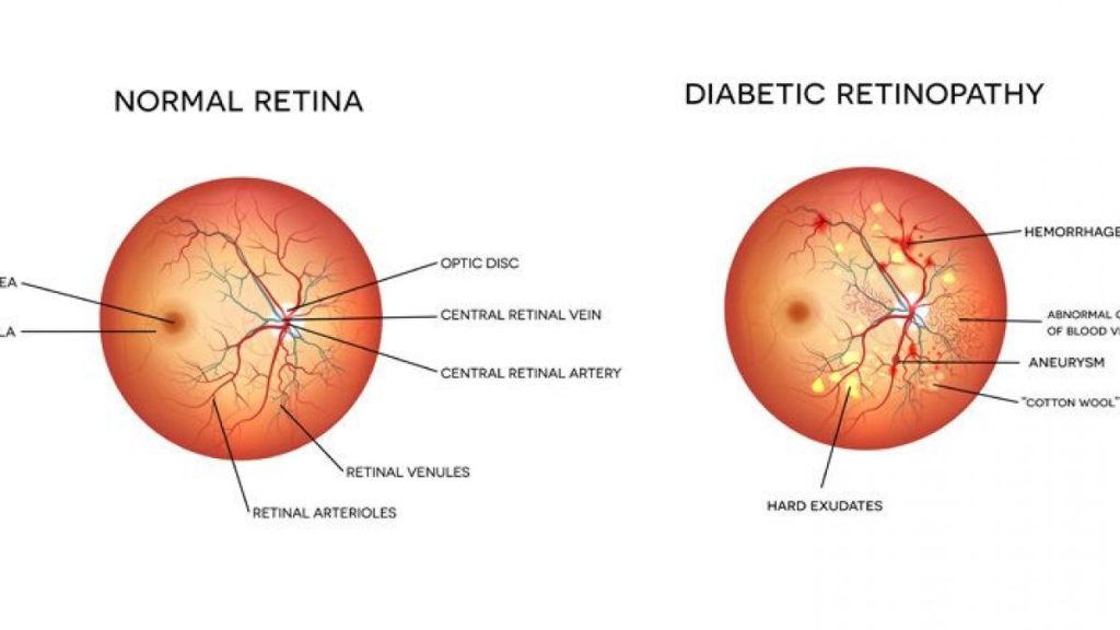 Diabetic Retinopathy - Featured Image