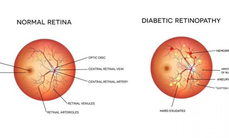 Diabetic Retinopathy - Featured Image