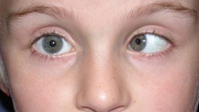 Photo of What is squint (strabismus)?| bharti eye foundation