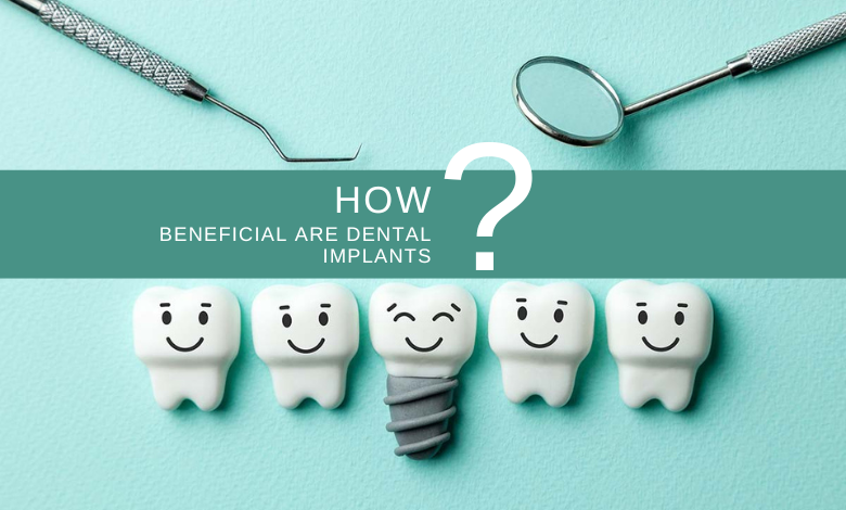 How Beneficial Are Dental Implants?