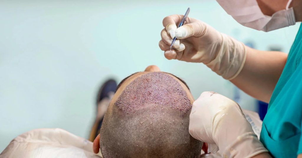 hair transplant in delhi