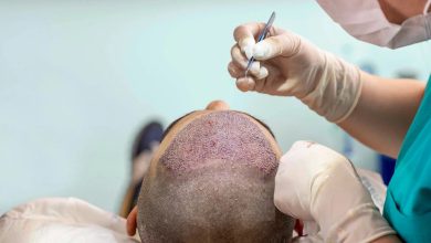 Photo of How to Get Best Hair transplant in Delhi through FUE