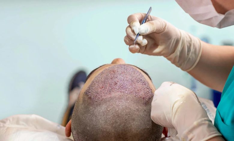 hair transplant in delhi